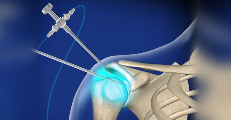 Shoulder Arthroscopy Surgery Panvel – Rotator Cuff & Shoulder Joint Specialist, Navi Mumbai